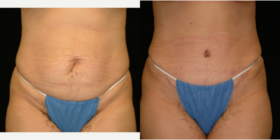 Case 553 - 25-34 year old woman treated with Tummy Tuck