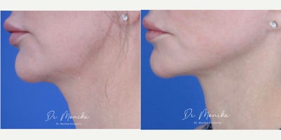 Case 5539 - Woman treated with ResurFX and Botox