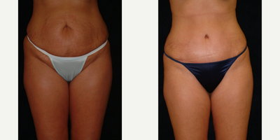Case 554 - 25-34 year old woman treated with Tummy Tuck