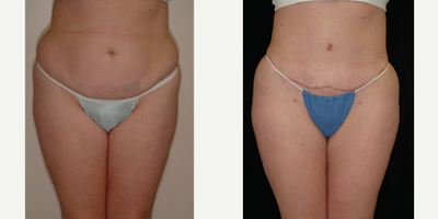 Case 555 - 25-34 year old woman treated with Tummy Tuck