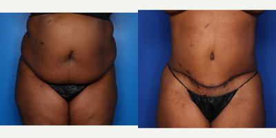 Case 556 - 35-44 year old woman treated with Tummy Tuck
