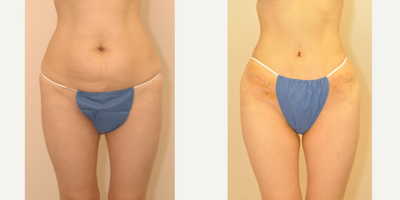 Case 557 - 35-44 year old woman treated with Tummy Tuck