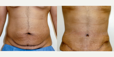 Case 558 - 35-44 year old man treated with Tummy Tuck