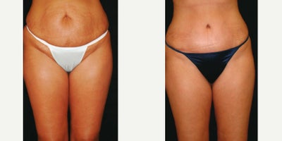 Case 559 - 25-34 year old woman treated with Tummy Tuck