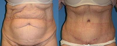 Case 561 - Woman treated with Tummy Tuck