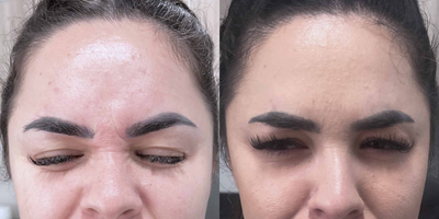 Case 5616 - 33 year old woman treated with Botox to Glabella