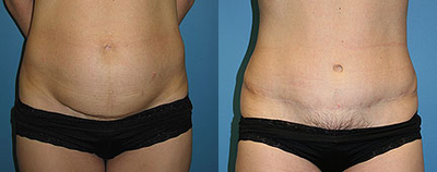 Case 562 - Woman treated with Tummy Tuck