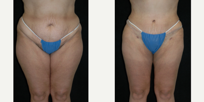 Case 563 - 25-34 year old woman treated with Tummy Tuck