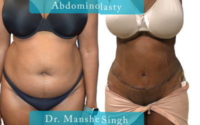 Case 564 - Woman treated with Tummy Tuck