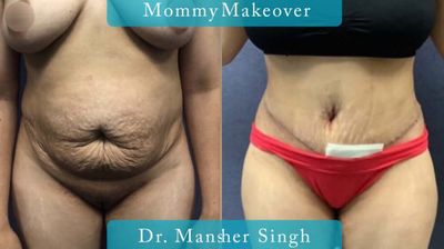 Case 565 - Woman treated with Tummy Tuck