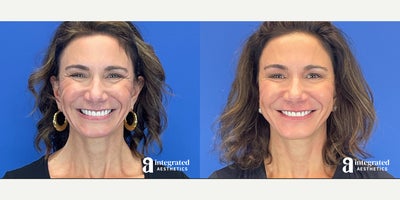 Case 5661 - 45-54 year old woman treated with Botox