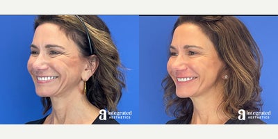 Case 5662 - 45-54 year old woman treated with Botox