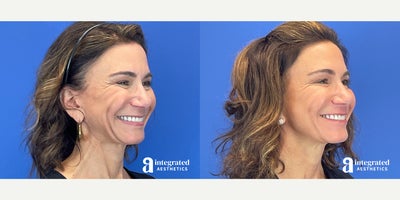 Case 5663 - 45-54 year old woman treated with Botox