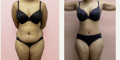 Case 567 - 35-44 year old woman treated with Tummy Tuck