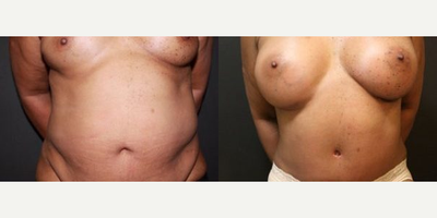 Case 568 - Woman treated with Tummy Tuck
