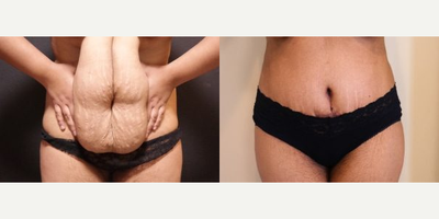 Case 569 - Woman treated with Tummy Tuck