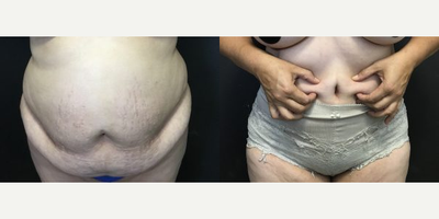 Case 570 - Woman treated with Tummy Tuck