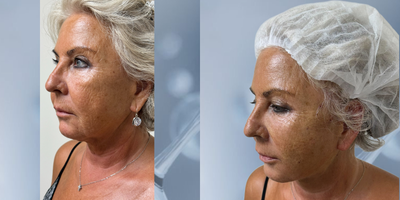 Case 5702 - 65-74 year old woman treated with Nonsurgical Facelift, Thread Lift, Nonsurgical Neck Lift, Botox