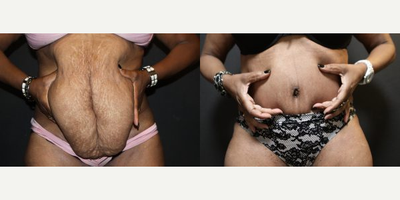 Case 571 - Woman treated with Tummy Tuck