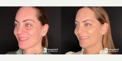 Case 5711 - 35-44 year old woman treated with Botox, Sculptra
