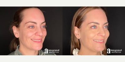 Case 5712 - 35-44 year old woman treated with Botox, Sculptra