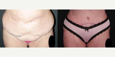 Case 572 - Woman treated with Tummy Tuck