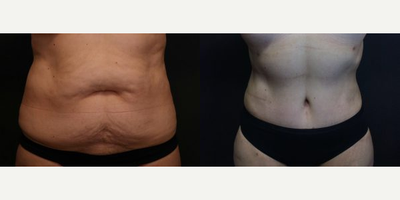 Case 573 - Woman treated with Tummy Tuck