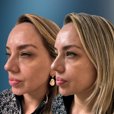 Case 5734 - 35-44 year old woman treated with Vampire Facelift, Botox, PRP Injections, Radiesse