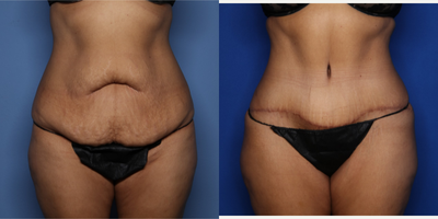 Case 574 - 35-44 year old woman treated with Tummy Tuck