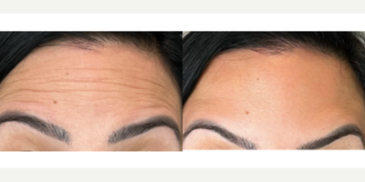 Case 5749 - 35-44 year old gender nonconforming person treated with Botox