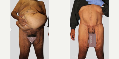 Case 575 - 55-64 year old man treated with Body Lift