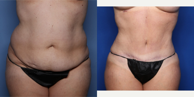 Case 576 - 45-54 year old woman treated with Tummy Tuck