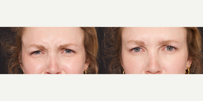 Case 5765 - Woman treated with Botox