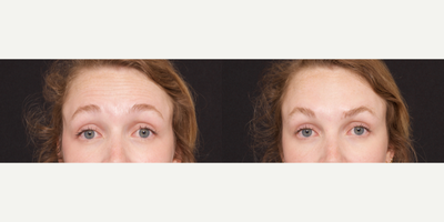 Case 5766 - Woman treated with Botox