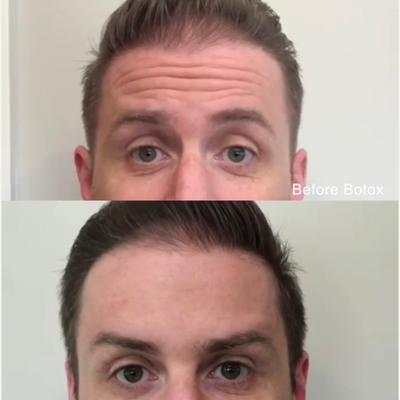 Case 5835 - 25-34 year old man treated with Botox