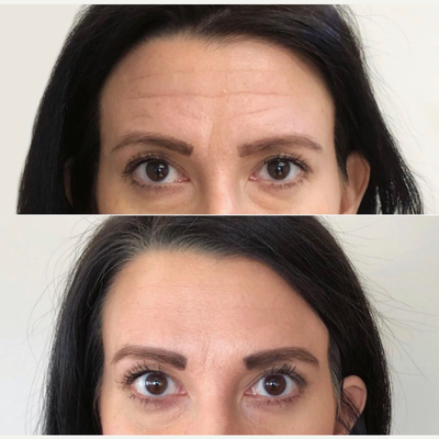Case 5836 - 25-34 year old woman treated with Botox