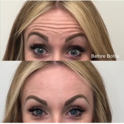 Case 5837 - 25-34 year old woman treated with Botox