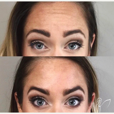 Case 5838 - 25-34 year old woman treated with Botox