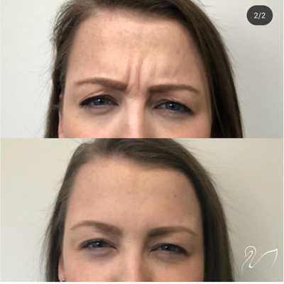 Case 5839 - 25-34 year old woman treated with Botox