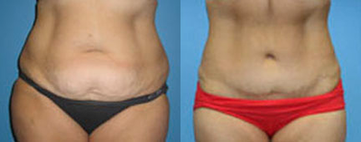 Case 584 - Woman treated with Tummy Tuck