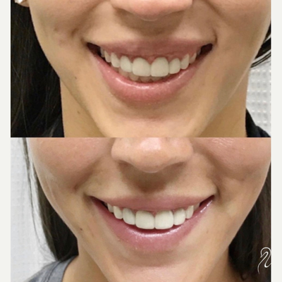 Case 5840 - 25-34 year old woman treated with Botox