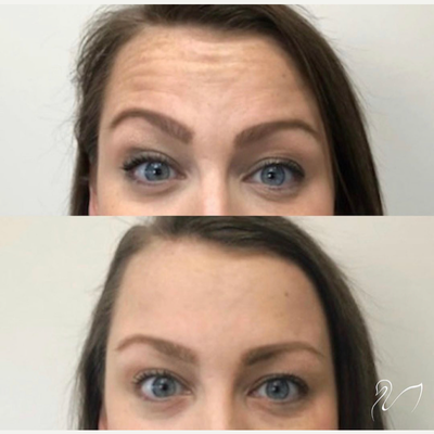 Case 5841 - 25-34 year old woman treated with Botox