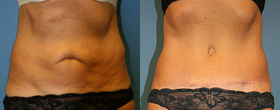 Case 585 - 65 year old woman treated with Tummy Tuck