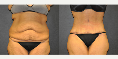 Case 586 - Woman treated with Tummy Tuck