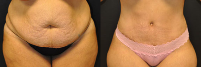 Case 587 - 30 year old woman treated with Tummy Tuck