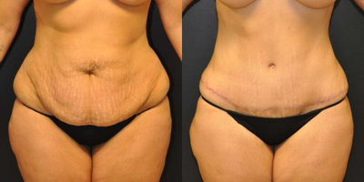 Case 588 - 40 year old woman treated with Tummy Tuck