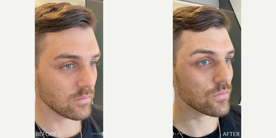 Case 5889 - FACIAL SCULPTING + BOTOX REFRESHER