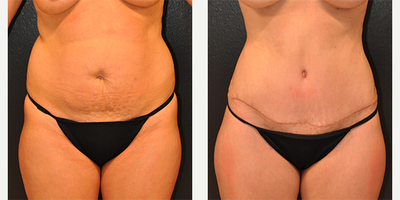 Case 589 - 36 year old woman treated with Tummy Tuck