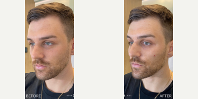 Case 5890 - FACIAL SCULPTING + BOTOX REFRESHER