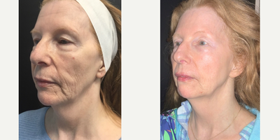 Case 5896 - 55-64 year old woman treated with NeoGen Plasma, Restylane, Lip Fillers, Dysport, Botox